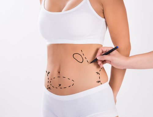 Liposuction