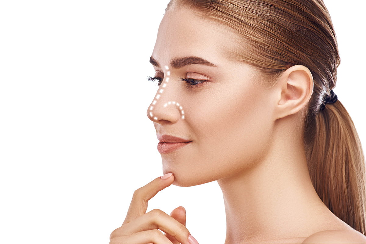 Rhinoplasty