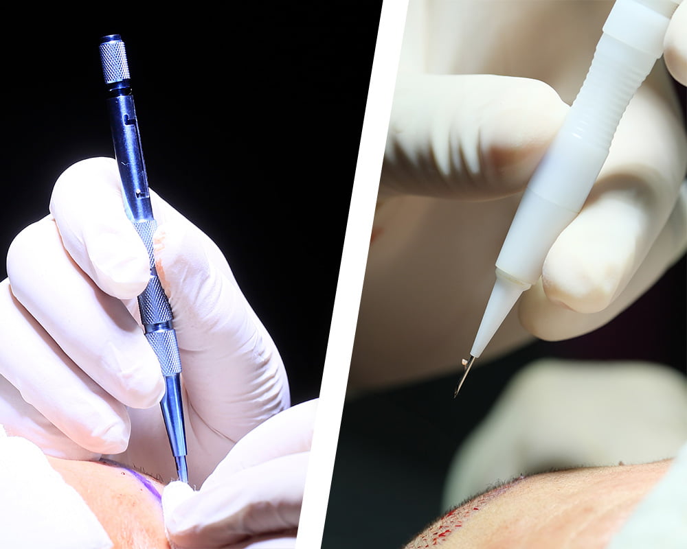 FUE_vs_DHI_hair_transplant